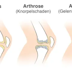 Vergleich von Gelenken: gesund, Arthrose (Knorpelschaden) und Arthritis (Gelenkentzündung). Arthritis zeigt eine Entzündung im Gelenk.