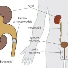 Czy badanie moczu wykryje kamicę nerkową? Sprawdź, co musisz wiedzieć