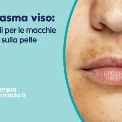 Primo piano del viso con melasma, evidenziando le macchie scure sulla pelle.