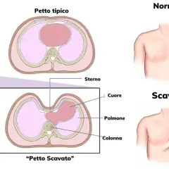 Confronto tra petto tipico e petto escavato nei bambini. Illustrazione anatomica mostra la forma del torace e la posizione degli organi interni.