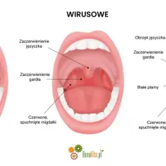 Porównanie gardła: normalne, wirusowe i bakteryjne. Czy angina jest zaraźliwa? Obraz pokazuje różnice w wyglądzie migdałków i gardła przy infekcjach.