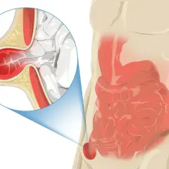 Hernie inguinale chez l'homme : une partie de l'intestin sort par une faiblesse de la paroi abdominale, près du pubis.