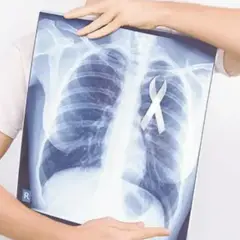 Rentgen klatki piersiowej z białą wstążką symbolizującą nadzieję na leczenie, np. pembrolizumabem.