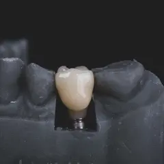Modello di arcata inferiore con impianto dentale e corona in ceramica.