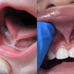 Bebé con frenillo corto en la boca, listo para una operacion frenillo boca.