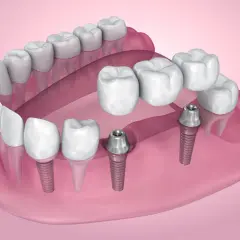 Nowoczesne mosty zębowe na implantach, przywracające pełny uśmiech.
