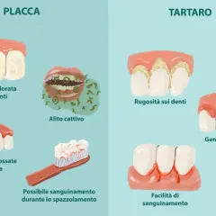 Illustrazione che mostra la differenza tra placca e tartaro: la placca causa patina, alito cattivo e gengive gonfie; il tartaro provoca rugosità, gengive gonfie e sanguinamento.