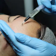 Close-up of a person receiving a PRX-T33 facial treatment with a syringe applying solution to the forehead.