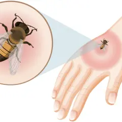 Nahaufnahme einer Biene auf einer Hand, die eine Rötung zeigt. Dies illustriert die Reaktion auf einen Wespenstich, der eine Allergie auslösen kann.