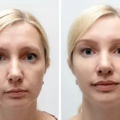 Porównanie twarzy przed i po jodze twarzy: widoczne wygładzenie zmarszczek i poprawa napięcia skóry.