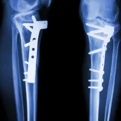 Rentgen nóg po zabiegu osteotomii. Widoczne zespolenia kości płytami i śrubami.