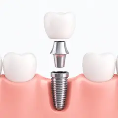 Componentes de un implante dental: tornillo, pilar y corona, listos para ser ensamblados en la encía.