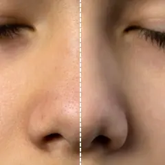 Före och efter-bild som visar hur laserbehandling minskar synligheten av stora porer på huden.