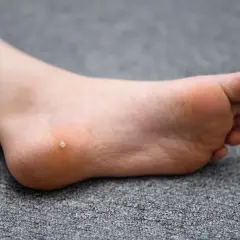 Piede di un bambino con una piccola verruca sul tallone.