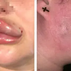 Co na opuchliznę ust po kwasie hialuronowym? Skuteczne metody łagodzenia bólu