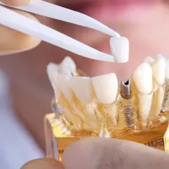 Modello di protesi dentale in zirconio, con pinzette che tengono una corona. Valutazione dei denti in zirconio: pro e contro.