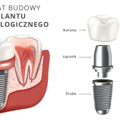 Schemat budowy implantu stomatologicznego. Dowiedz się, ile kosztuje implant zęba 6 i jak jest zbudowany: śruba, łącznik i korona.
