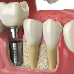 Immagine 3D di un impianto dentale inserito nell'osso, con una corona in cima. Si vedono anche denti naturali e gengive. Informazioni su innesto osseo dentale effetti collaterali.