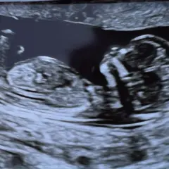 Ecografia 14 settimane: profilo del feto, testa e corpo visibili. Si attende di scoprire se è maschio o femmina.