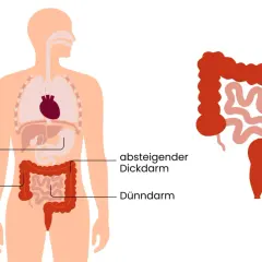 Illustration zeigt den menschlichen Verdauungstrakt mit Markierungen für Magen, Dickdarm und Dünndarm. Rechts ist ein vergrößerter Dickdarm mit einem Geschwür abgebildet, das auf Darmkrebs im Dickdarm hinweist.