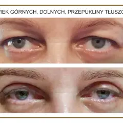 Przed i po zabiegu usunięcia przepukliny tłuszczowej powiek górnych. Widoczne zmiany w wyglądzie okolic oczu.