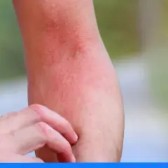 Alergia na leki: Rozpoznaj objawy i działaj! Poradnik krok po kroku