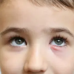 Czy dziecko z jęczmieniem może iść do przedszkola bez obaw?