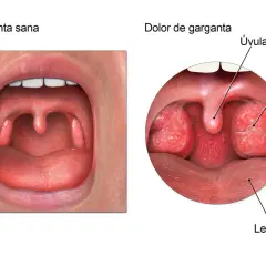 Medicamentos para el dolor de garganta: alivia el malestar rápidamente
