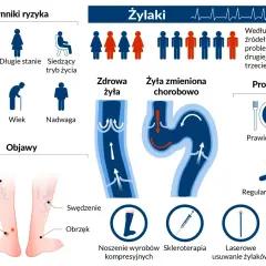Widoczne nogi z widocznymi pajęczynami naczyniowymi. Lupa powiększa fragment skóry, uwidaczniając żylaki.
