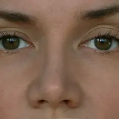 Oczy kobiety z lekko opadającą powieką, rozważającej zabieg botox.
