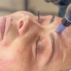 Zabieg mezoterapii mikroigłowej w trakcie. Skóra lekko zaczerwieniona, widoczne drobne nakłucia. Pytanie "mezoterapia mikroigłowa jak często" jest kluczowe dla efektów.