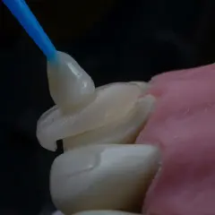 Precyzyjna odbudowa zęba na włóknie szklanym. Dentysta aplikuje materiał na model.