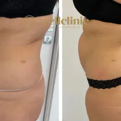 Liposukcja: Modelowanie sylwetki czy to rozwiązanie dla Ciebie?