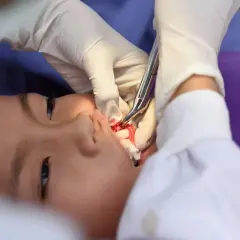 Krwawienie po wyrwaniu zęba jak długo trwa i kiedy jest niebezpieczne