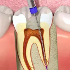 Procedimiento dental: un instrumento limpia el nervio de una muela al aire, mostrando el interior del diente.