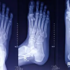 Radiografie del piede destro mostrano una frattura non consolidata con sintomi evidenti.