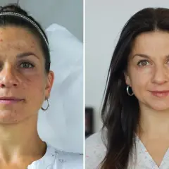 Przed i po zabiegu: skóra z niedoskonałościami i przebarwieniami staje się gładka i promienna. Czy to zasługa fibryny?