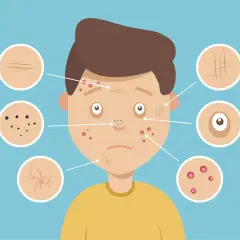 Ilustracja pokazuje problemy skórne, takie jak zaskórniki i wypryski, które mogą dotyczyć 13-latka. Szukamy co na trądzik dla 13 latka.