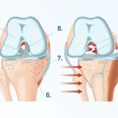 Anatomia zdrowego kolana po lewej, po prawej uszkodzone kolano z zerwanym więzadłem.
