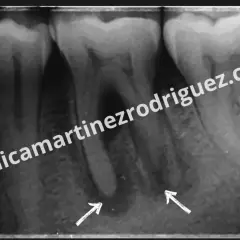 Radiografía dental muestra una posible infección endodoncia con áreas radiolúcidas en ápices radiculares, señaladas por flechas.