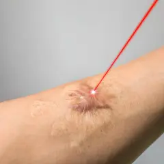 Czerwony promień lasera skierowany na bliznę na skórze ramienia, symbolizujący nowoczesne leczenie blizn.
