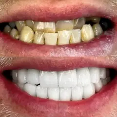 Ile licówek potrzebujesz? Od 1 zęba po Hollywood Smile!