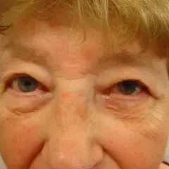 Nahaufnahme eines Gesichts mit Falten um die Augen. Ein gelblicher Fleck ist am rechten Unterlid sichtbar, ein mögliches Symptom eines Aderhautmelanoms.