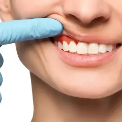 Ból zęba? Czerwone, opuchnięte dziąsła mogą wymagać antybiotyku na zęba. Dentysta bada dziąsła.