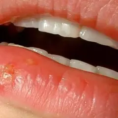 Labio con herpes, ampollas y costras. ¿Cuánto dura un herpes labial?