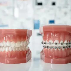 Dwa modele szczęk: jeden z przezroczystymi nakładkami, drugi z metalowym aparatem samoligaturującym a klasycznym.