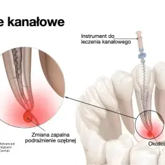 Leczenie kanałowe: Objawy, przyczyny i kiedy jest konieczne?
