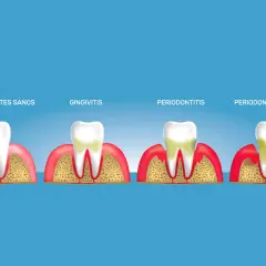 Ilustración muestra la progresión de la gingivitis a periodontitis, con encías y dientes sanos, gingivitis, periodontitis y periodontitis avanzada.
