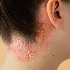 Piel irritada y escamosa en el cuello, posible alergia al cloro de piscina que causa problema respiratorio.