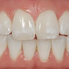 Denti con macchie bianche visibili, che potrebbero indicare problemi di smalto o ipomineralizzazione.